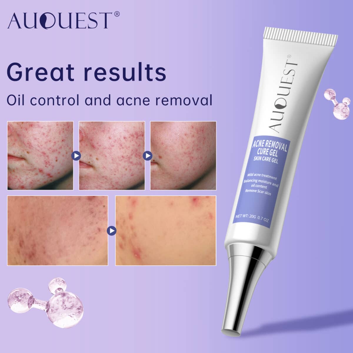 Auquest-herbal-acne-treatment-cream-pimple-spot-removal-for-teens-oil-control-acne-scar-gel-shrink-1