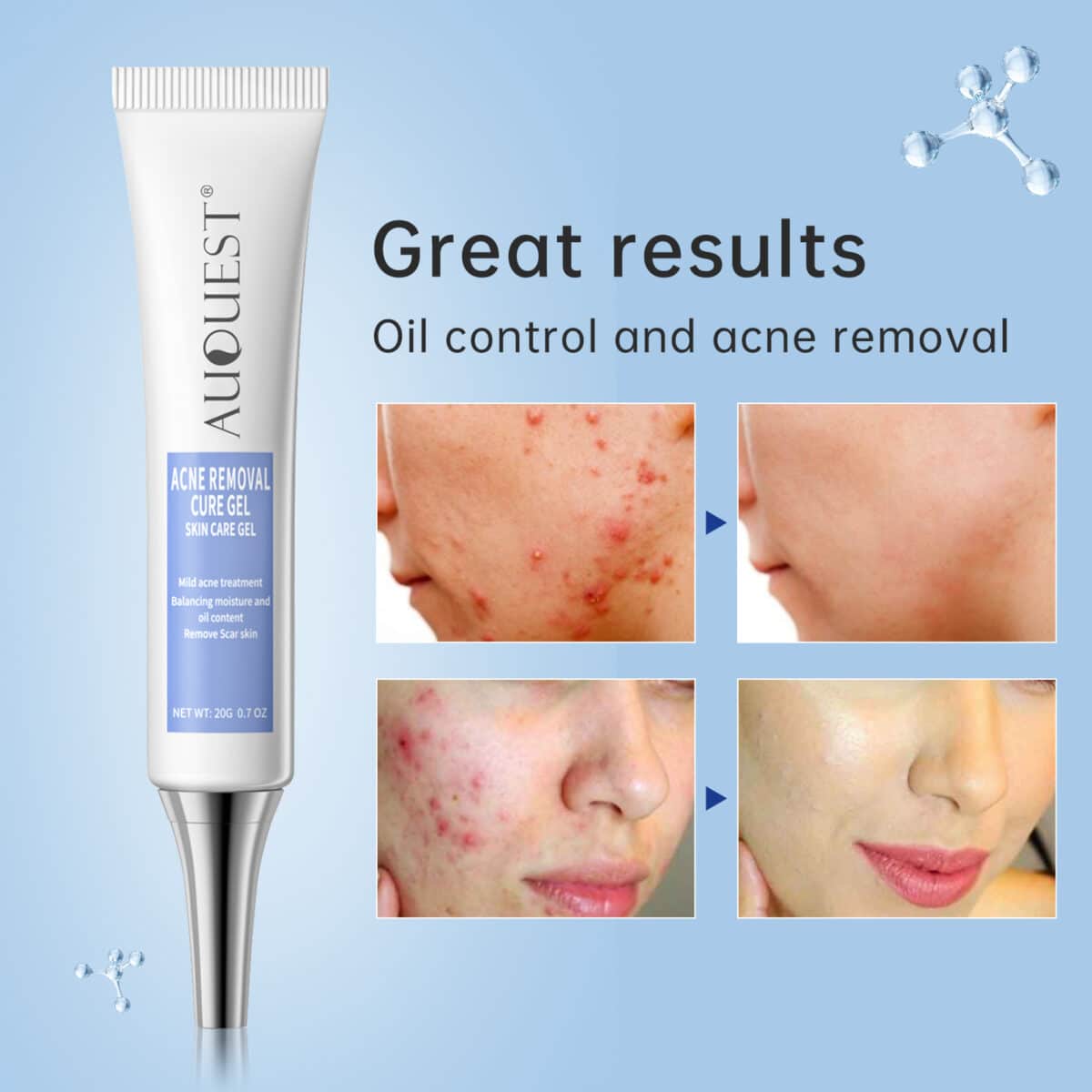 Auquest-herbal-acne-treatment-cream-pimple-spot-removal-for-teens-oil-control-acne-scar-gel-shrink-4