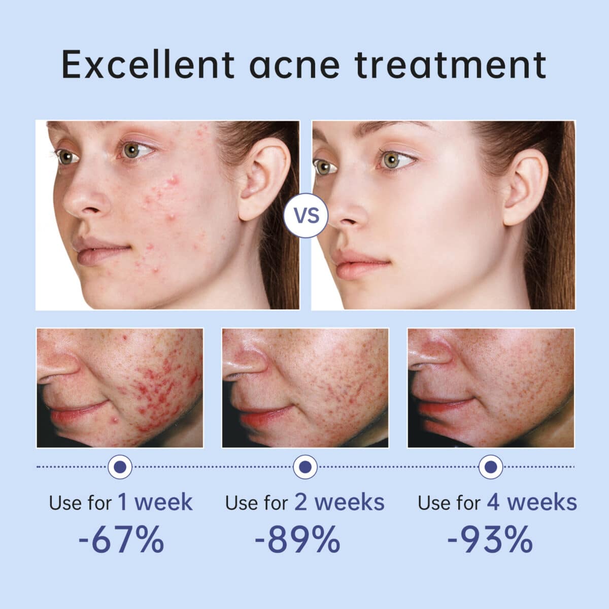 Auquest-herbal-acne-treatment-cream-pimple-spot-removal-for-teens-oil-control-acne-scar-gel-shrink-5