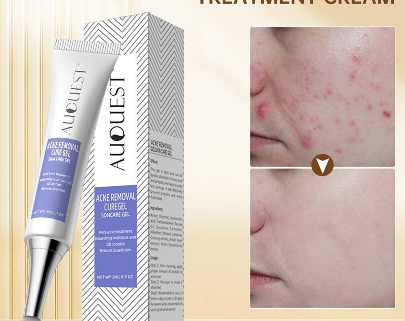 Auquest-herbal-acne-treatment-cream-pimple-spot-removal-for-teens-oil-control-acne-scar-gel-shrink
