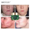 Breylee-acne-pimple-patch-acne-treatment-serum-face-sheet-mask-facial-acne-cream-essence-facial-skin-4