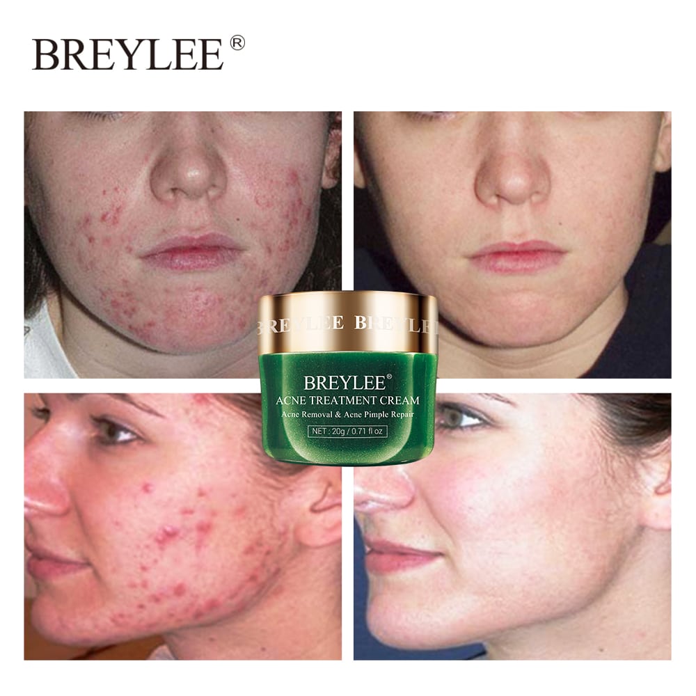 Breylee-acne-pimple-patch-acne-treatment-serum-face-sheet-mask-facial-acne-cream-essence-facial-skin-4
